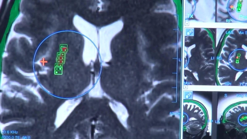 Các nhà khoa học Bỉ giải mã thành công bệnh Parkinson