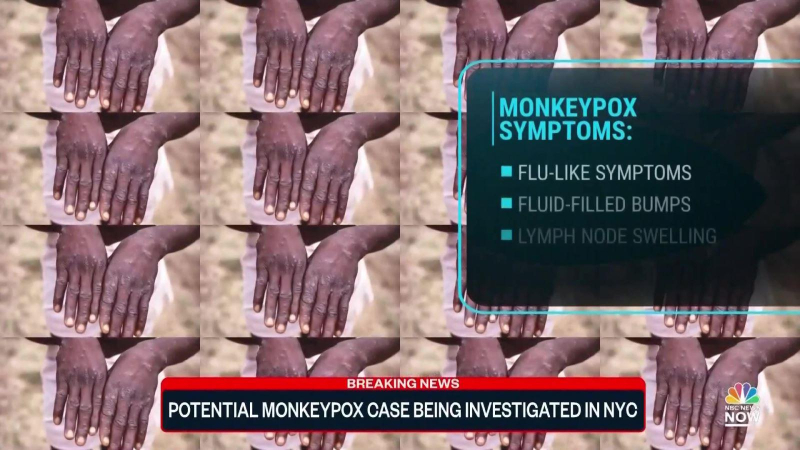 Bệnh đậu mùa khỉ không có nguy cơ lây lan thành đại dịch