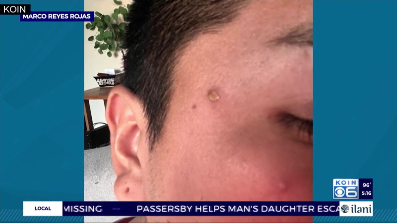 C&aacute;ch ly bệnh nh&acirc;n đậu m&ugrave;a khỉ