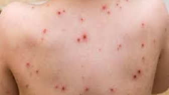 Quảng Ngãi chủ động phòng chống bệnh đậu mùa khỉ