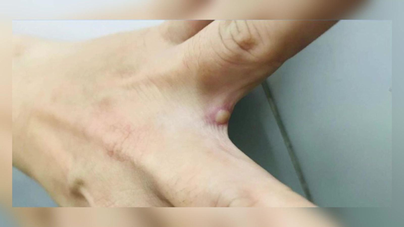 Bệnh nh&acirc;n đầu ti&ecirc;n mắc đậu m&ugrave;a khỉ đ&atilde; &acirc;m t&iacute;nh với virus