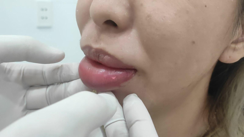 Rước họa từ làm đẹp cấp tốc