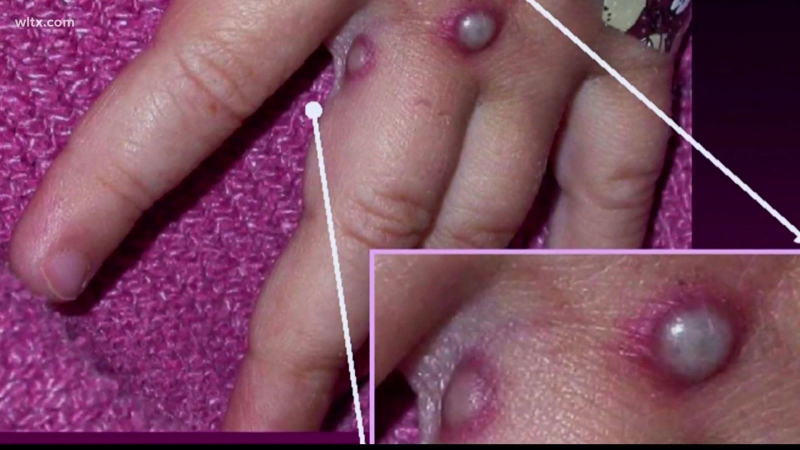 WHO duy trì cảnh báo cao nhất với dịch đậu mùa khỉ