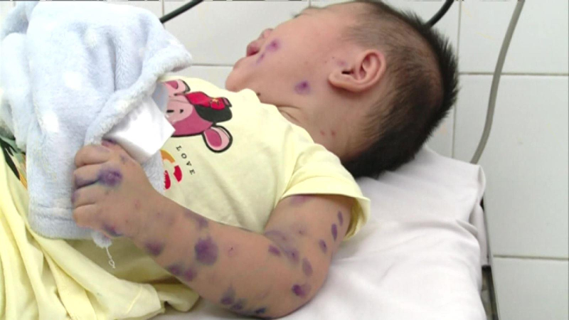 Virus gây bệnh tay chân miệng nặng tái xuất hiện tại TP.HCM