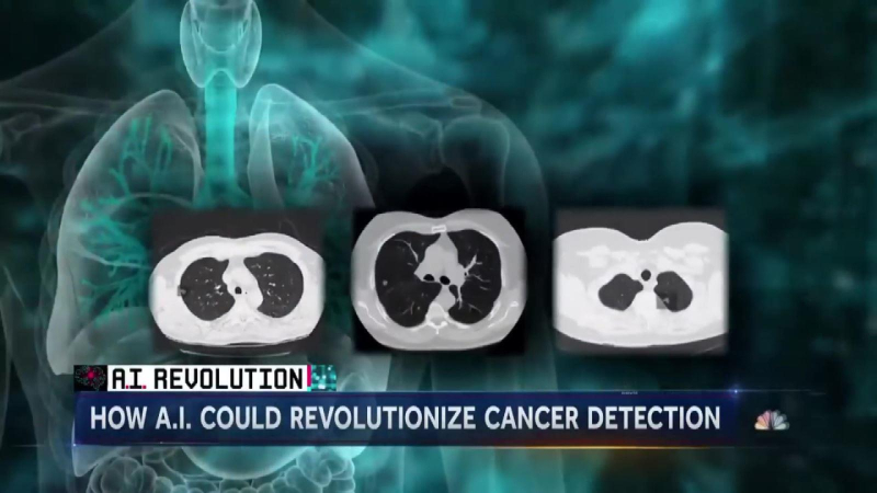 AI giúp chẩn đoán ung thư vú