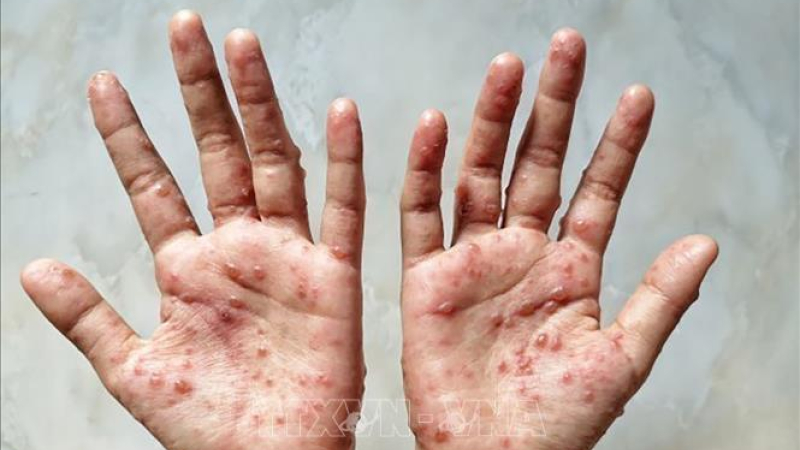 Ph&aacute;t hiện trường hợp mắc bệnh đậu m&ugrave;a khỉ đầu ti&ecirc;n tại L&agrave;o