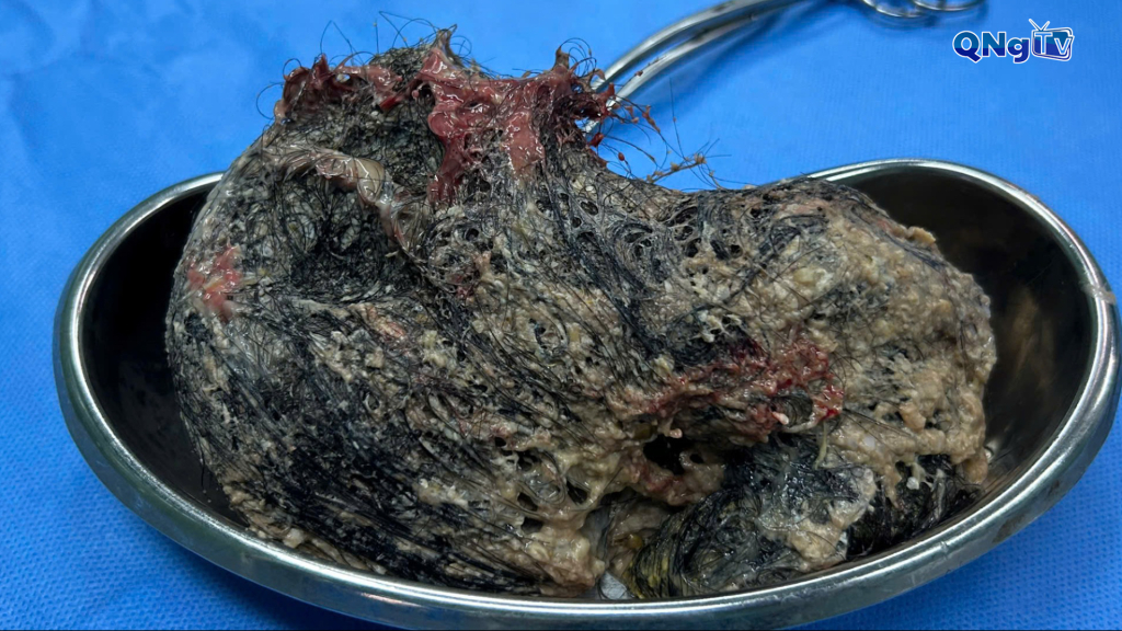 Búi tóc nặng nửa ký được lấy ra khỏi dạ dày bệnh nhi 6 tuổi.