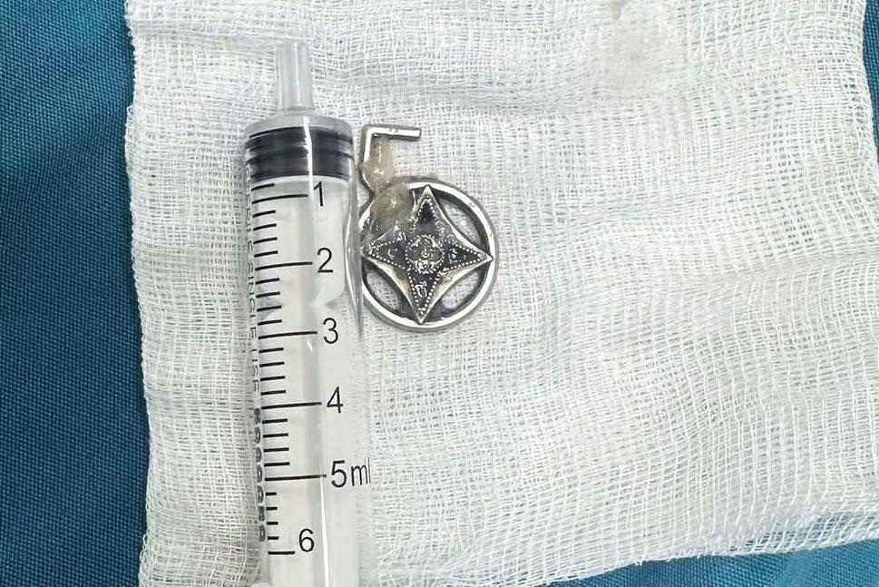 Dị vật sau khi được lấy ra.