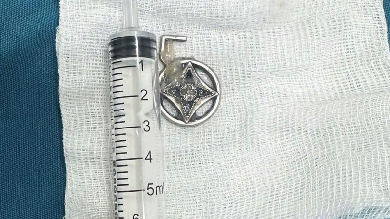 Gắp th&agrave;nh c&ocirc;ng dị vật nguy hiểm cho bệnh nhi 30 th&aacute;ng tuổi