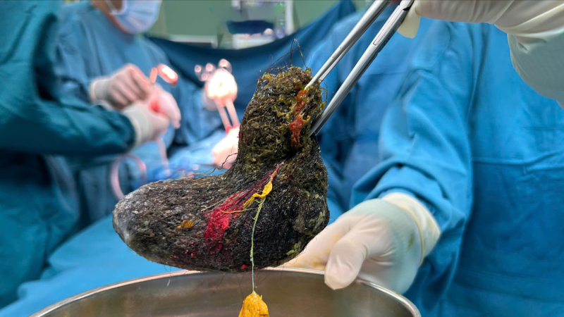 Phẫu thuật lấy b&uacute;i t&oacute;c lớn trong dạ d&agrave;y bệnh nhi