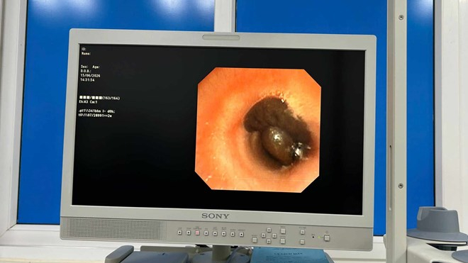 Kịp thời gắp con đỉa sống trong đường thở cho bệnh nhi ở Quảng Ng&atilde;i
