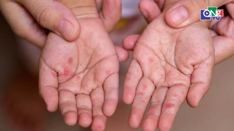 Cảnh b&aacute;o nguy cơ gia tăng ca bệnh tay ch&acirc;n miệng