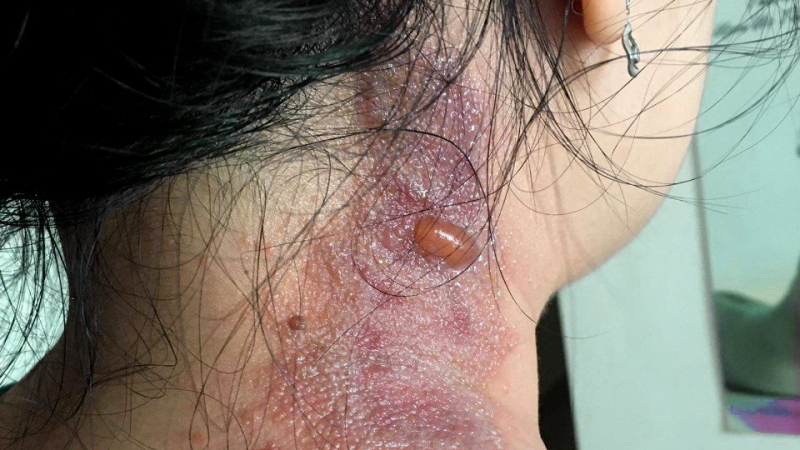 Cảnh gi&aacute;c vi&ecirc;m da do kiến ba khoang, tr&aacute;nh nhầm với zona