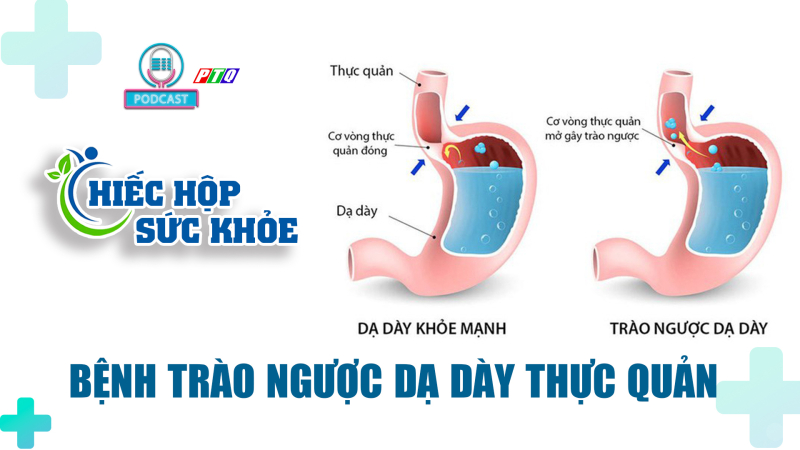 Cách phòng bệnh trào ngược dạ dày thực quản 